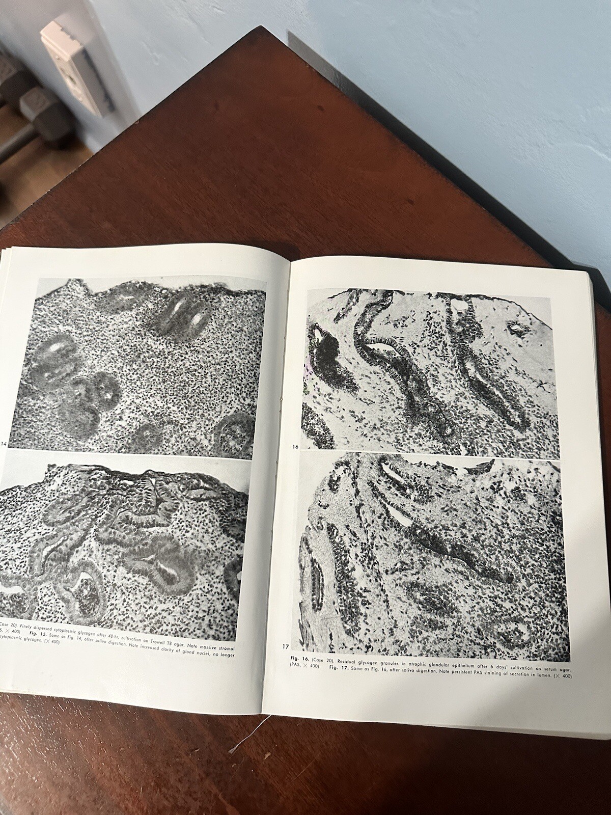 Obstetrics and Gynecology Journal Vol 17 No 4 Paul Hoeber April 1961 ** FLAWS