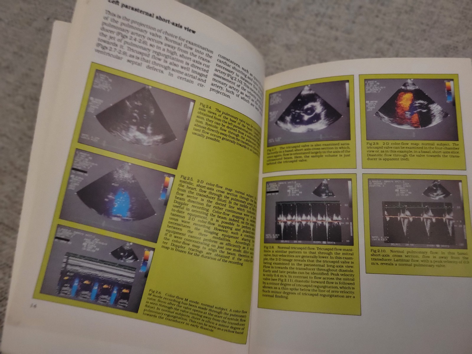 Echocardiography Made Easy Bundle