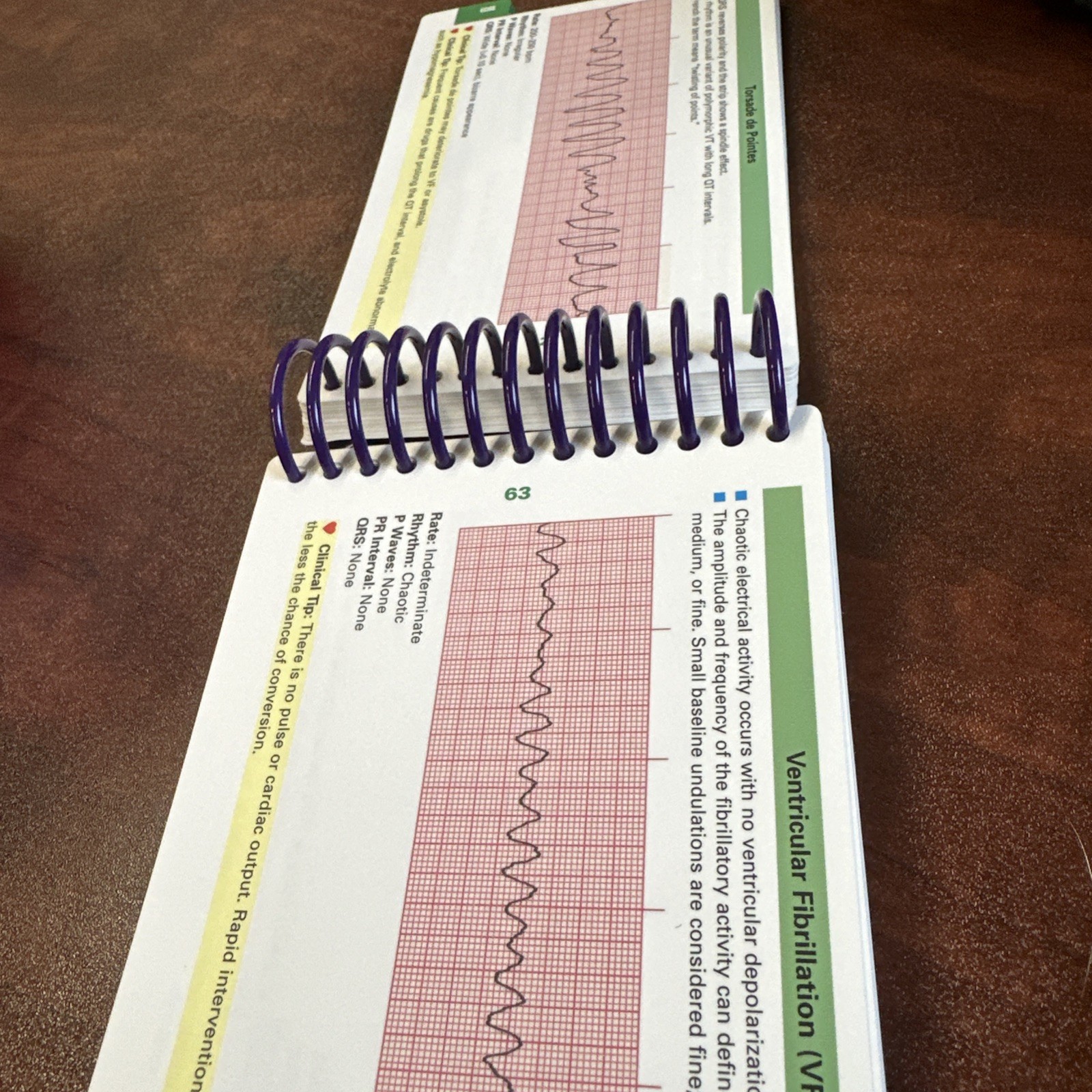 ECG Notes: Interpretation and Management Spiral-bound By Jones, Shirley Nursing
