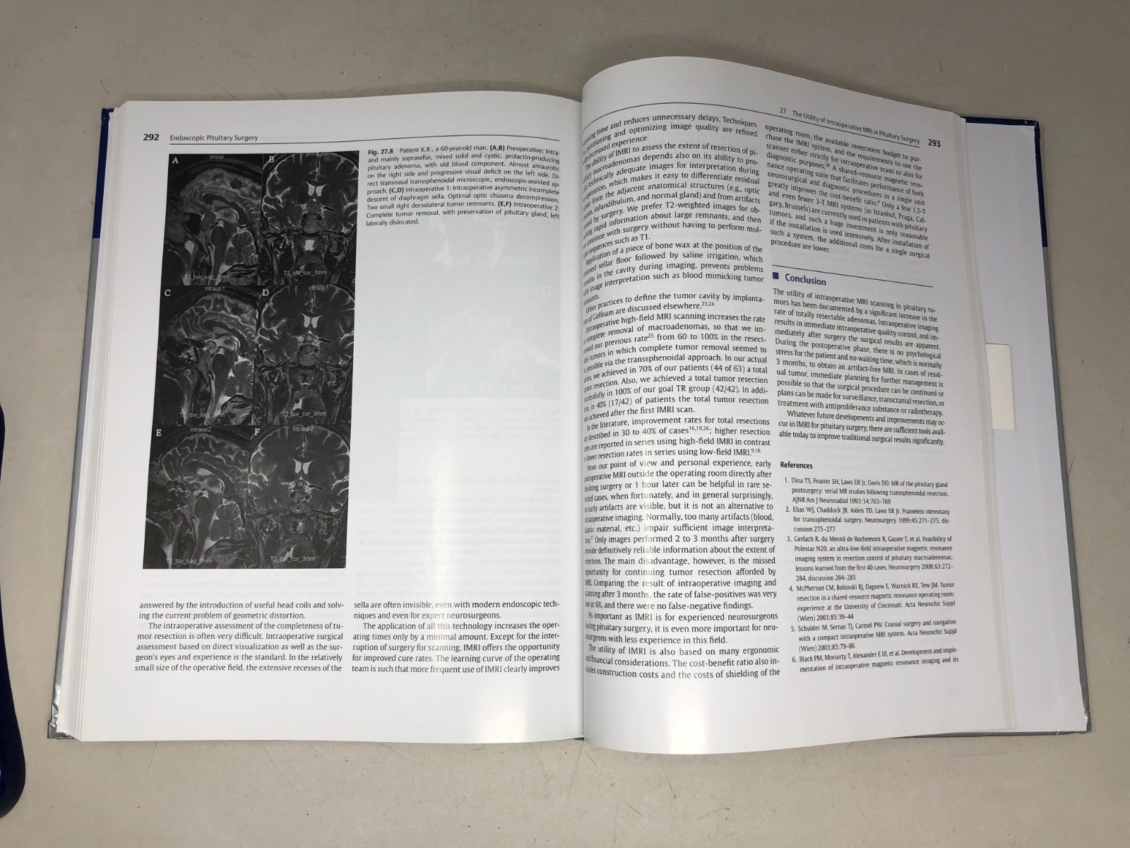 Endoscopic Pituitary Surgery, 2012, E-118