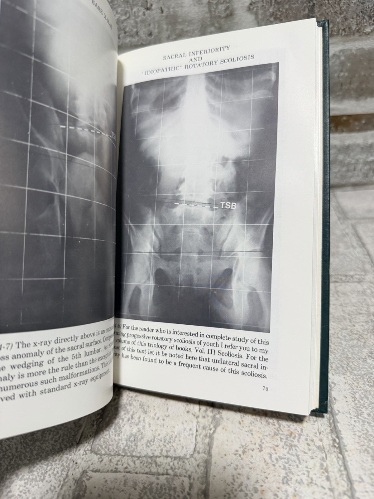 Chiropractic Technic Tortipelvis Hardcover Book Vol 1 Slipped Disc Syndrome 1994