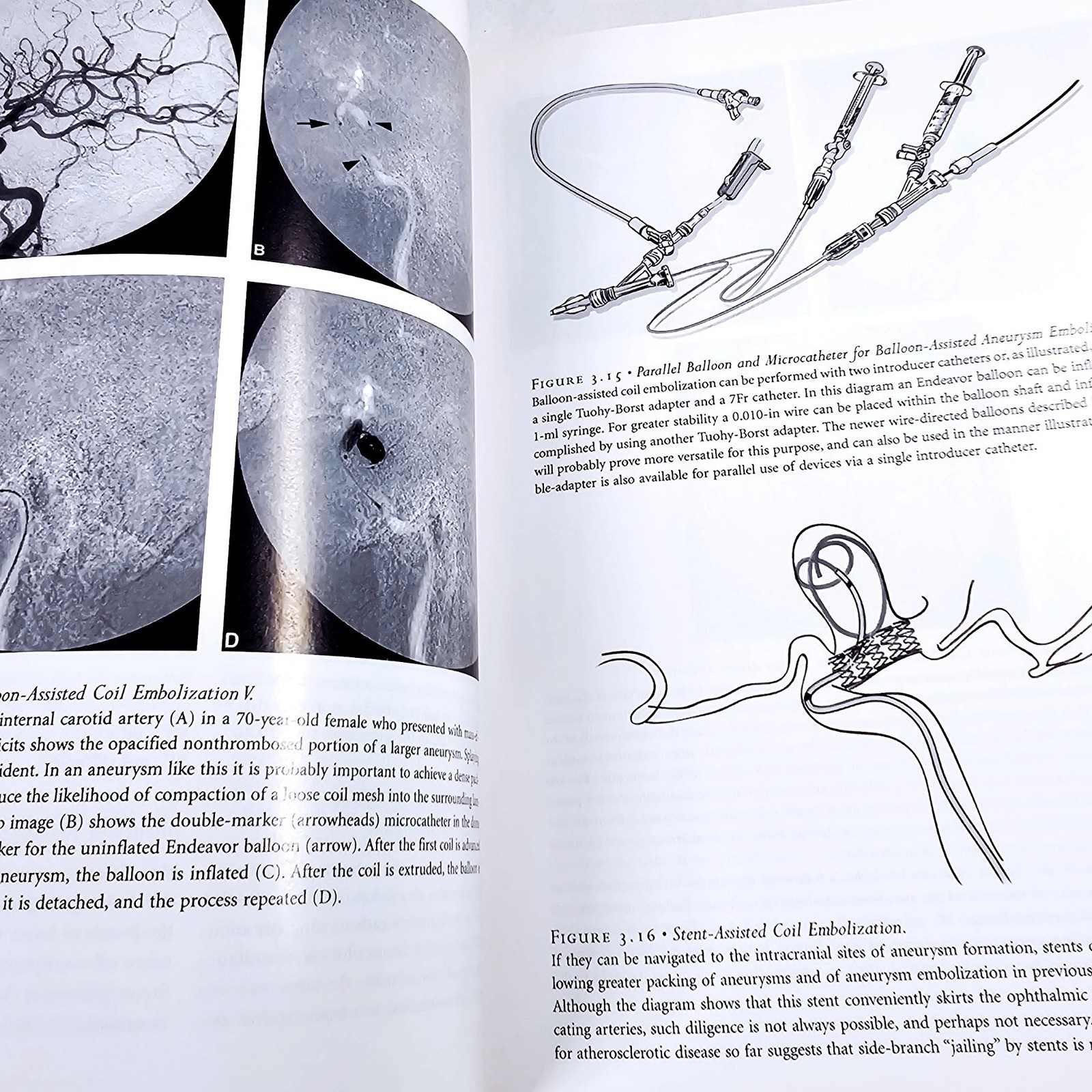 Springer Interventional Endovascular Therapy Nervous System Pearse Morris SZ VTG
